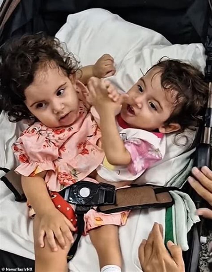 Bateson Conjoined Twins Are A ‘Miracle’ As Parents Share, Photos On Reddit