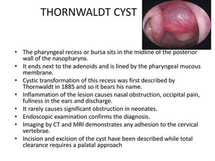 Can Tornwaldt's cyst cause symptoms?