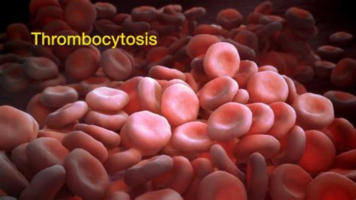 Is thrombocytosis life threatening?