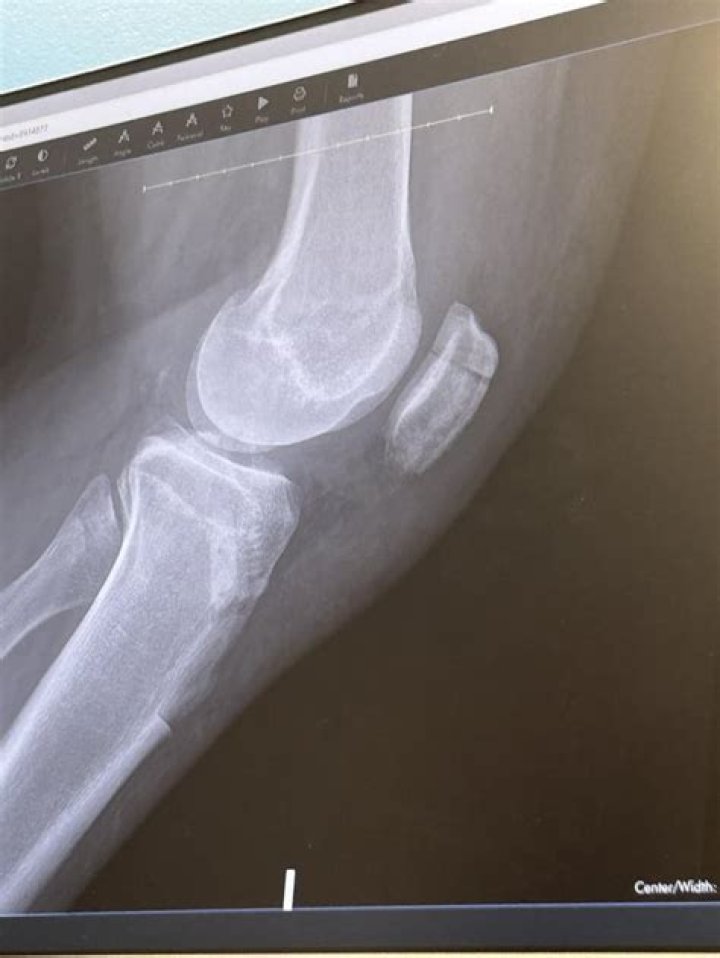 
What Happened To Ryan Papenhuyzen? NRL Star Fractured Knee Cap Injury Update 